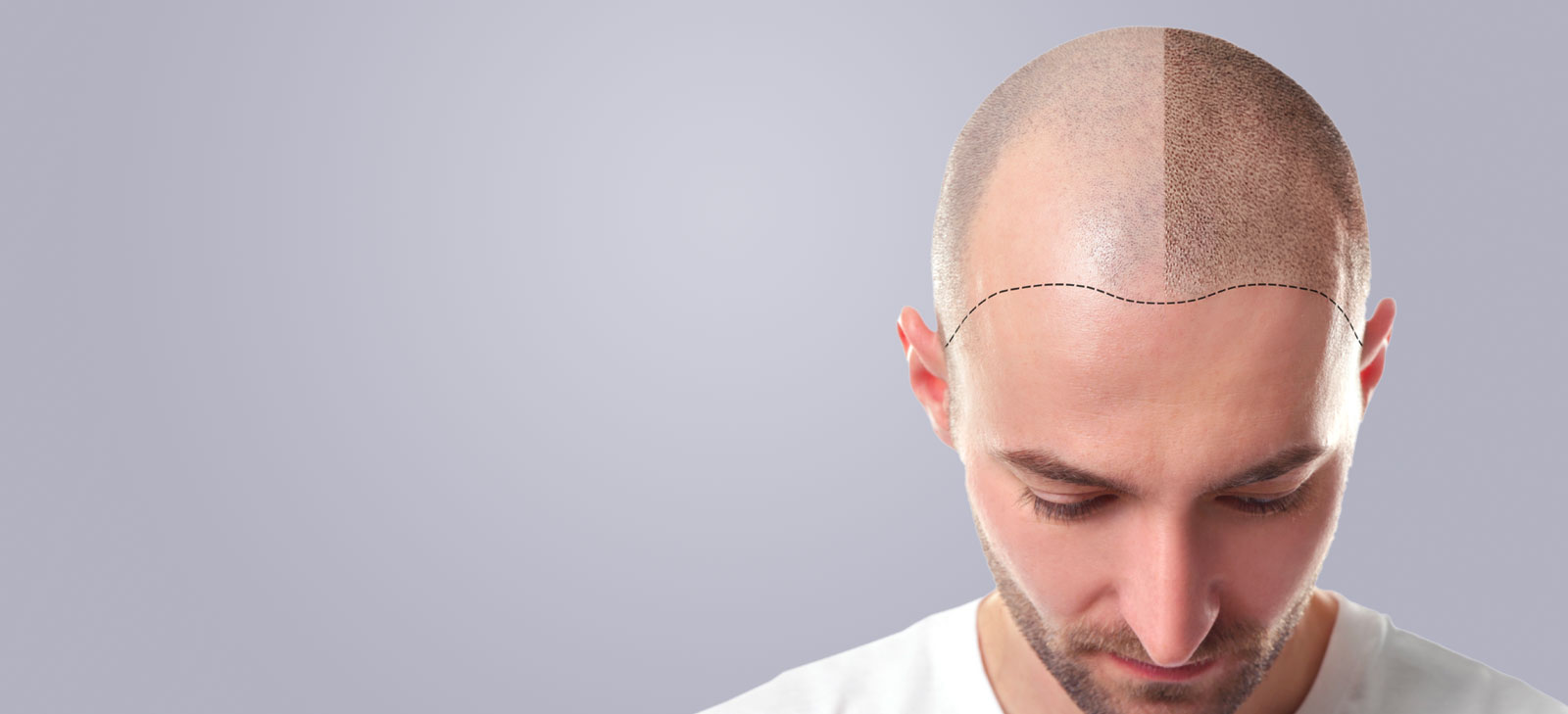 greffe-cheveux