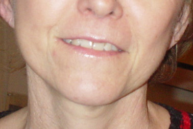 lifting01-after