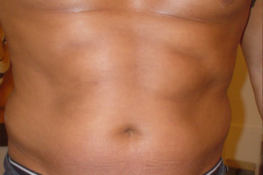 lipo01-a