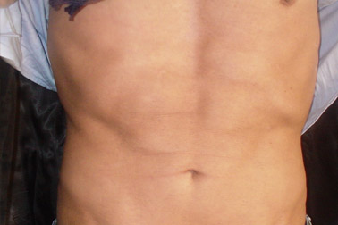 lipo01-b