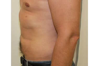 lipo02-b